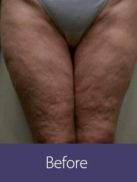 Cellulite Reduction Before & After Image