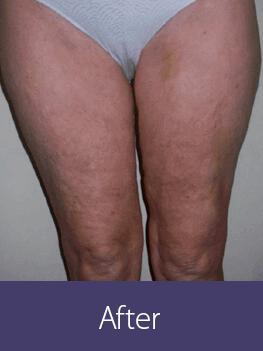 Cellulite Reduction Before & After Image