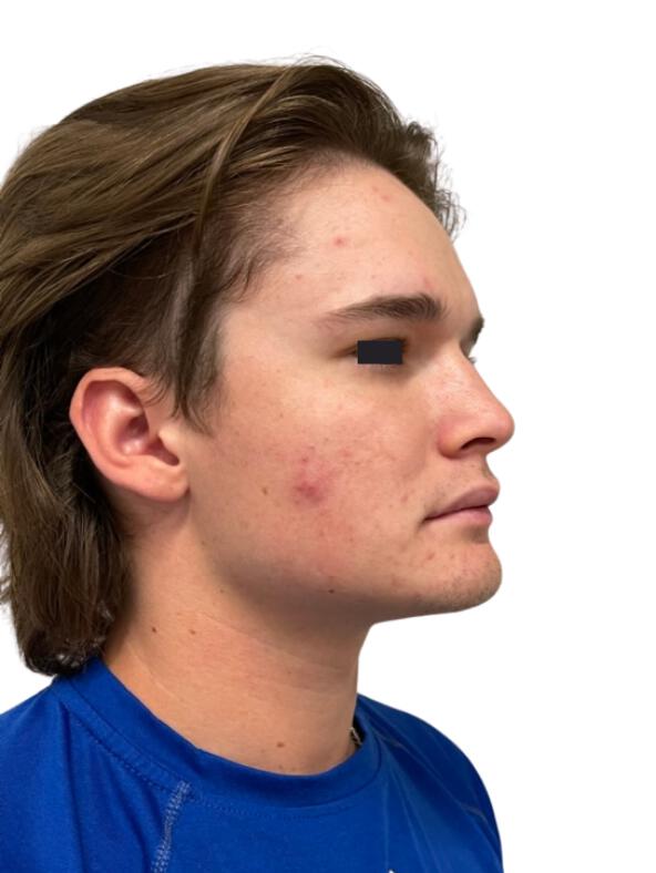 Acne Treatments Before & After Image