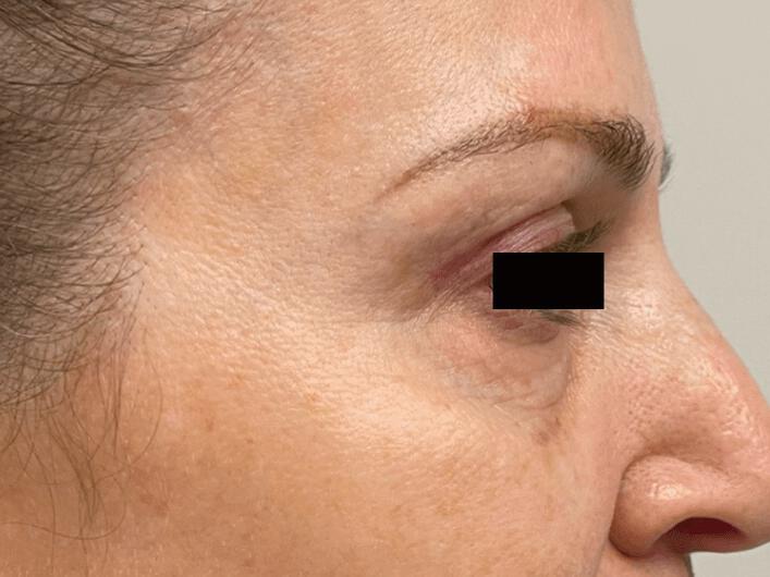 ClearLift™ Before & After Image