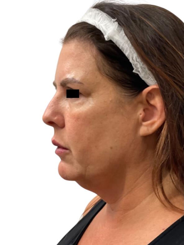 CO2 Laser Resurfacing Before & After Image