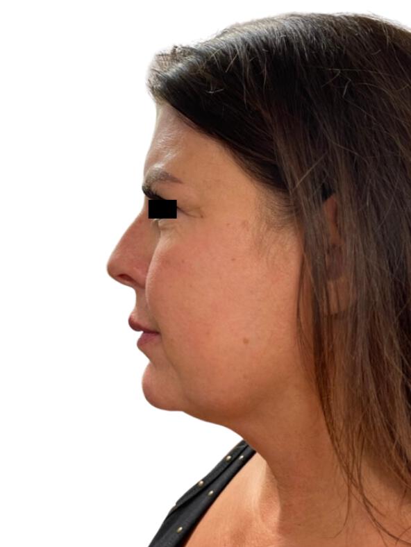 CO2 Laser Resurfacing Before & After Image