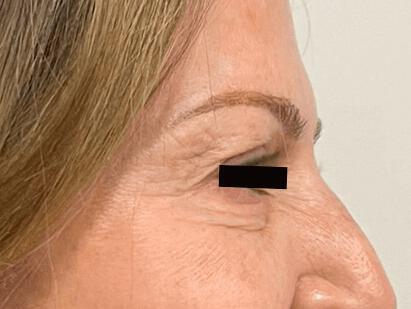 Laser Skin Tightening Before & After Image