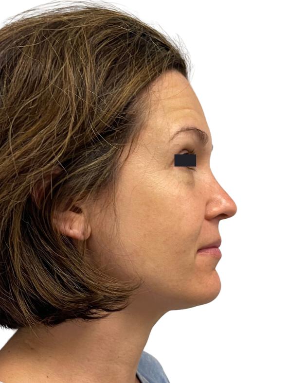 Resurfacing Treatments Before & After Image